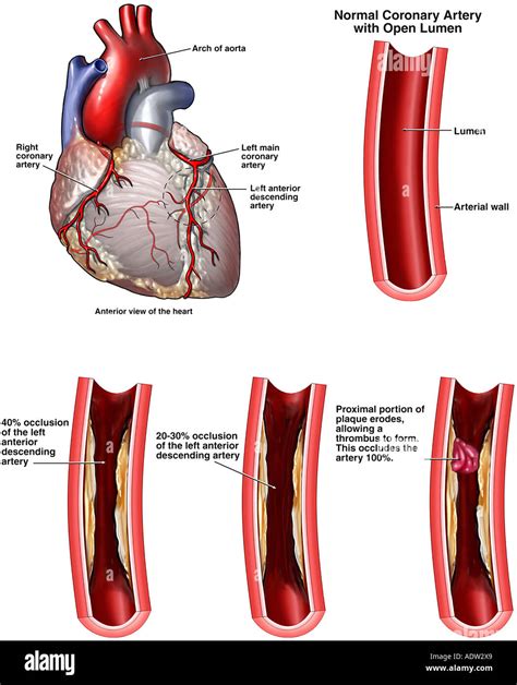 coronary artery disease deutsch